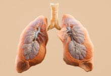 Lung Cancer in People Who Never Smoked is Rising