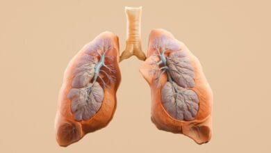 Lung Cancer in People Who Never Smoked is Rising